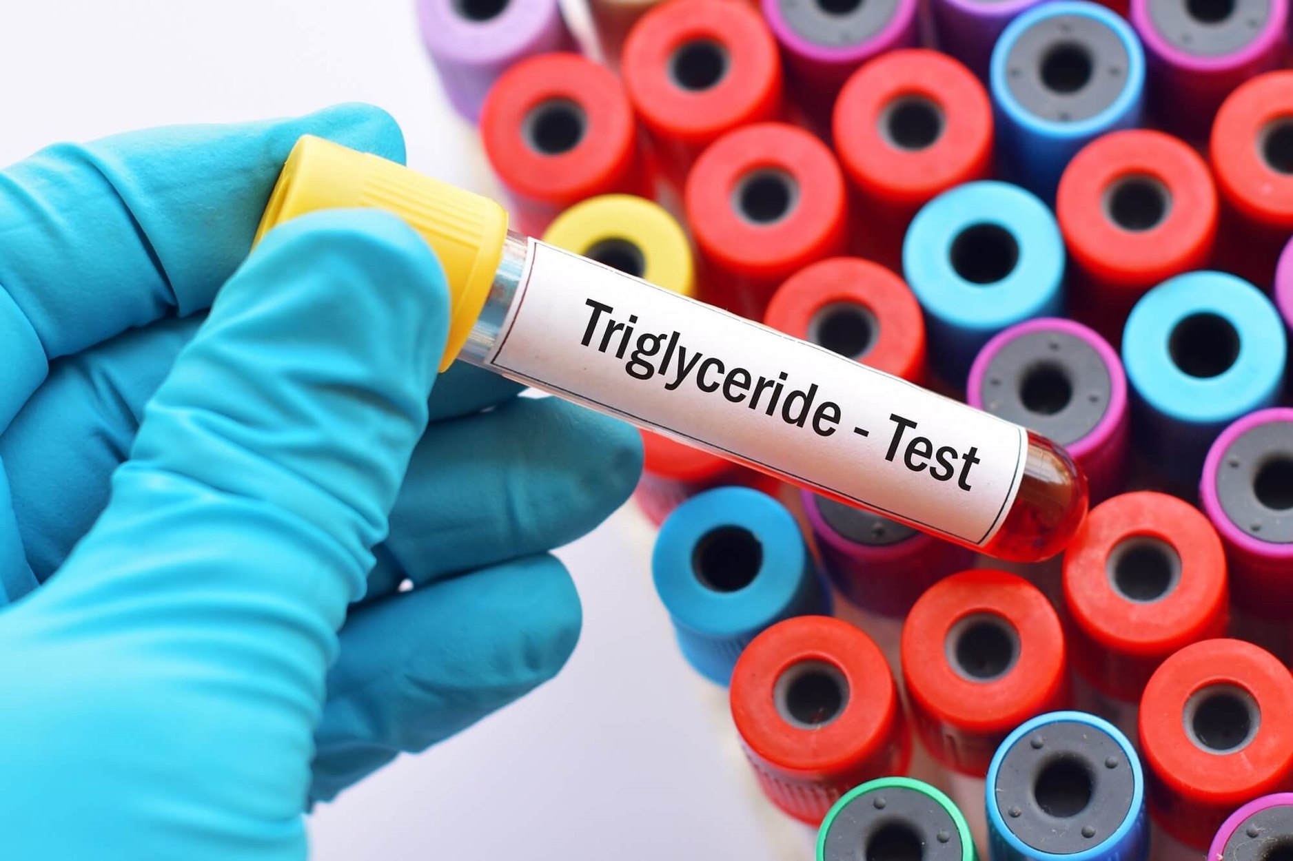 Przygotowanie do wiarygodnego badania trójglicerydów Próbówka z krwią pobrana na czczo do badania